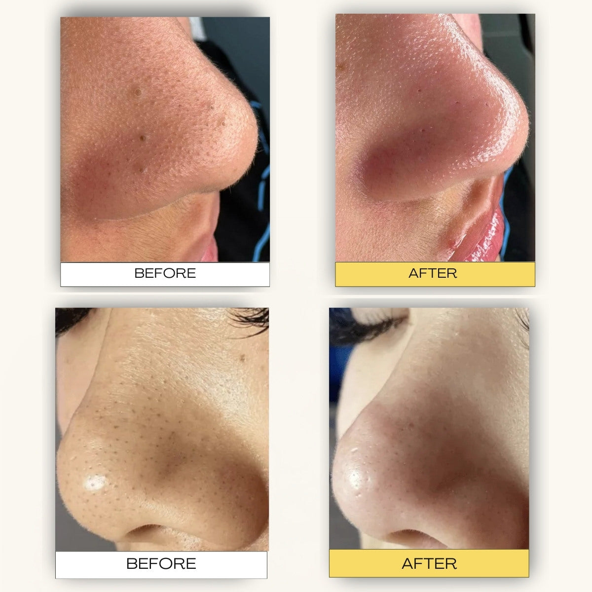 Pore Cleansing Patch System