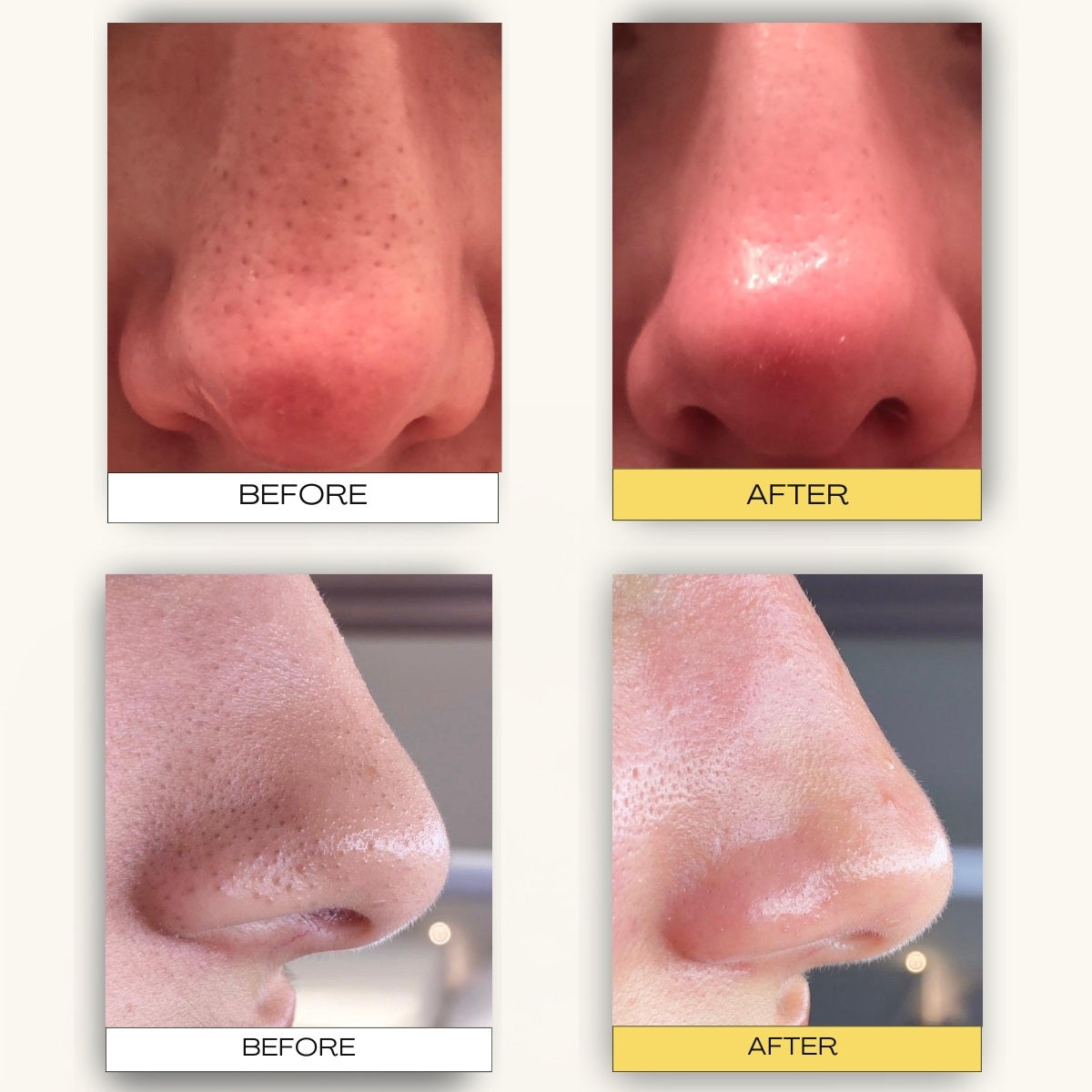Pore Cleansing Patch System