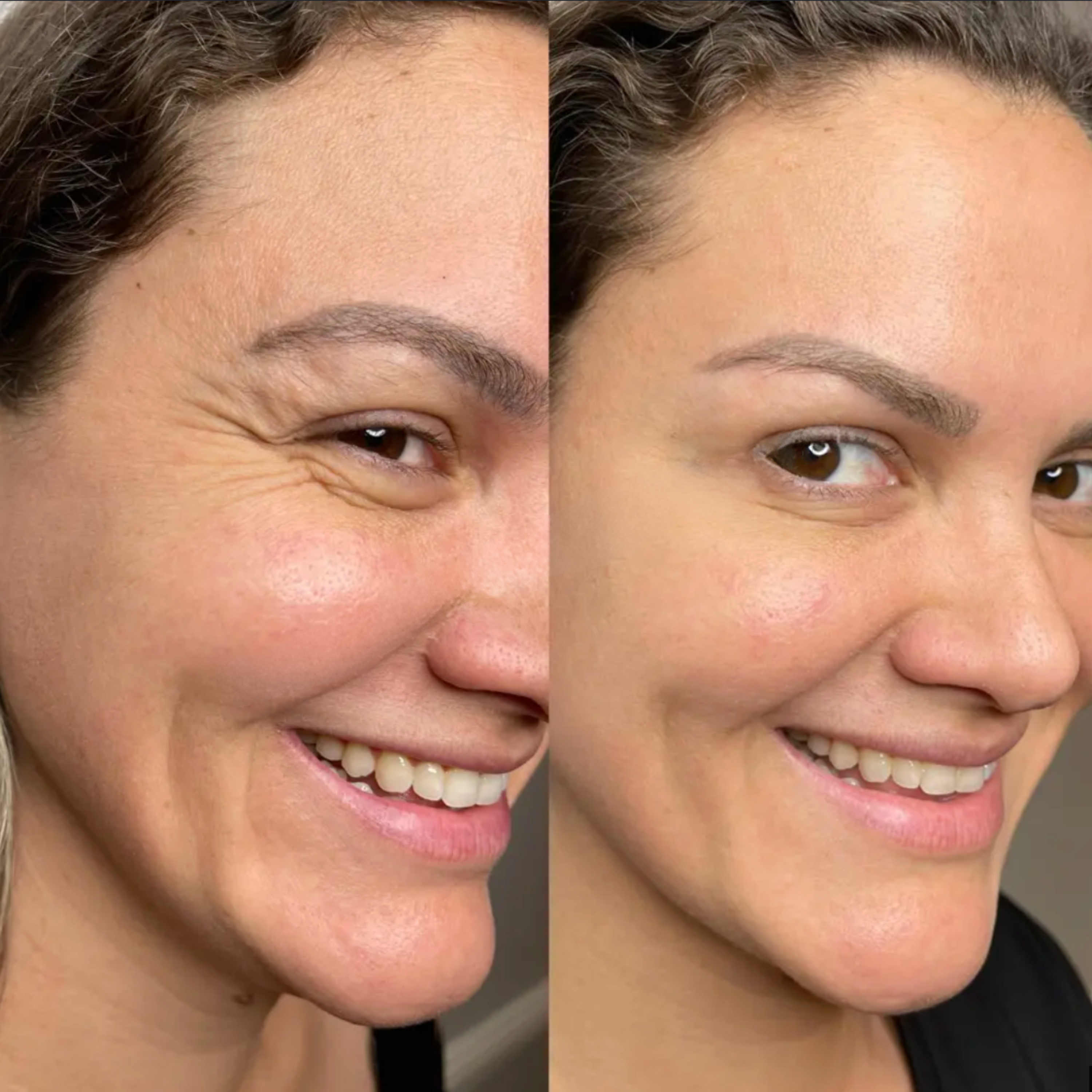 Luelle Wrinkle Smoothing Patches