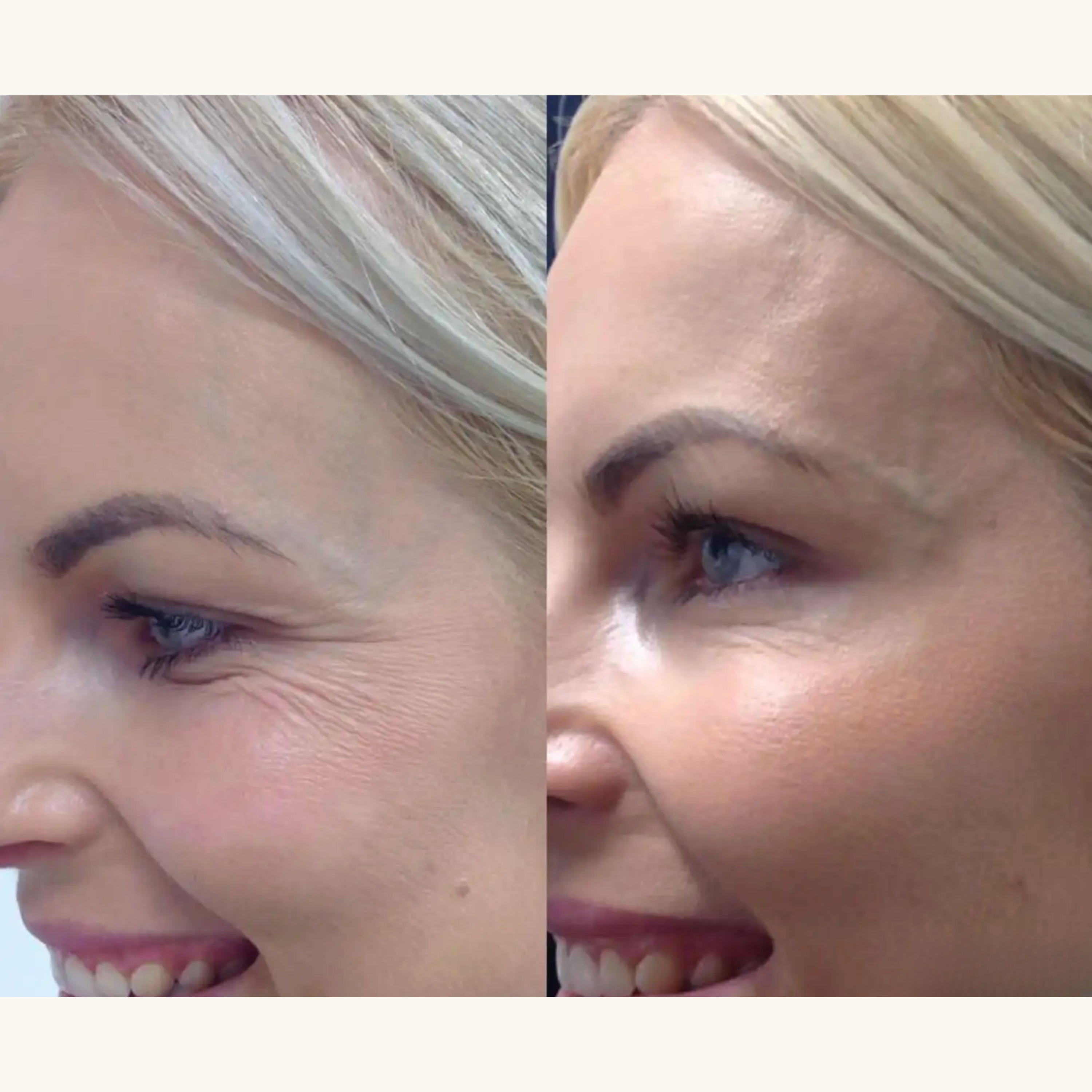 Luelle Wrinkle Smoothing Patches