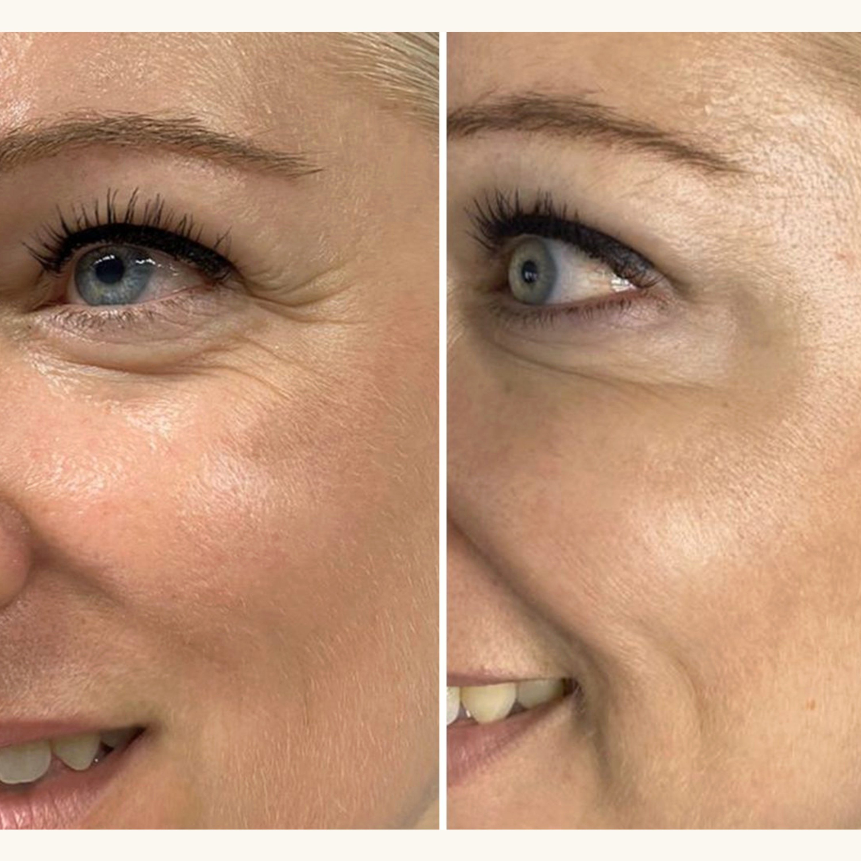 Luelle Wrinkle Smoothing Patches