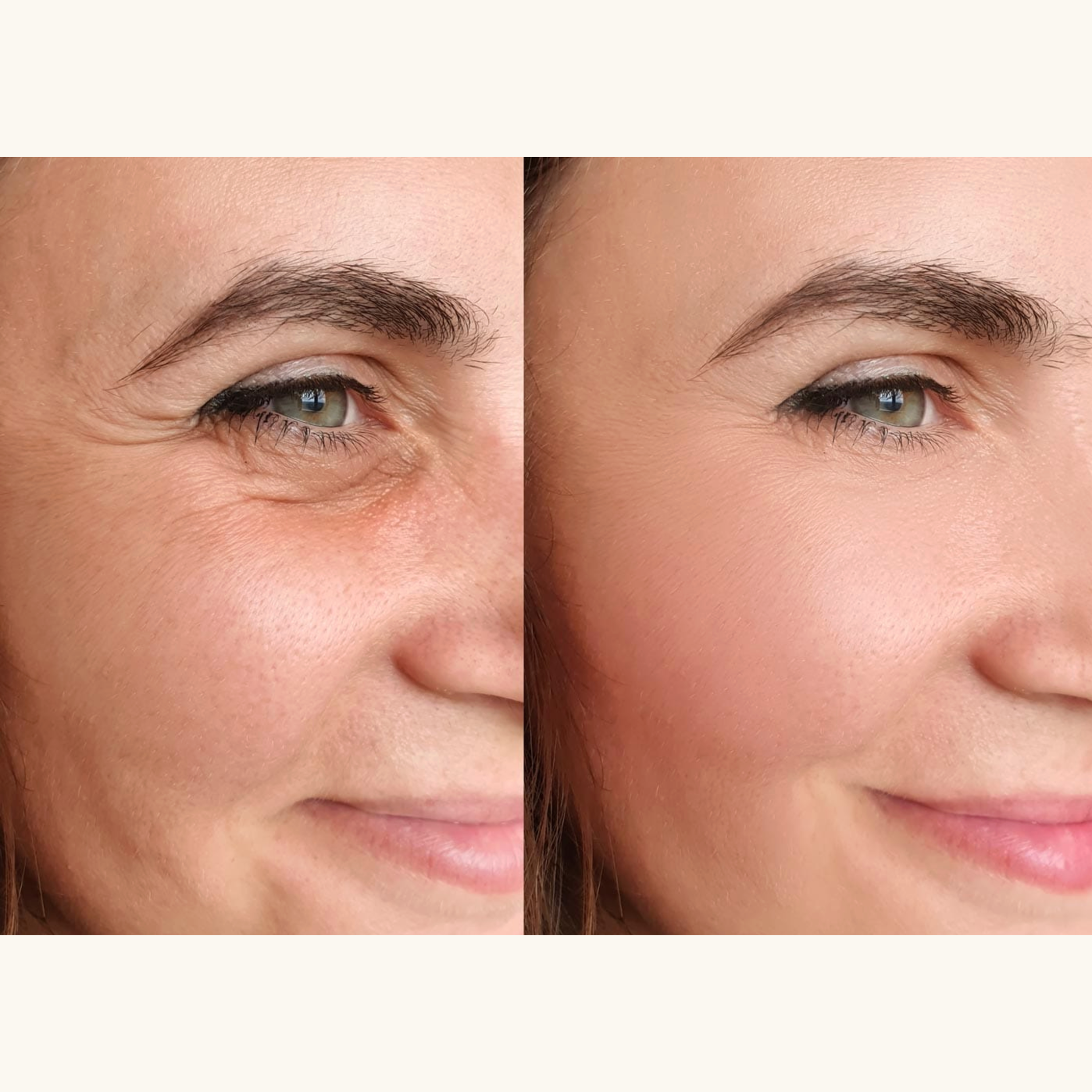 Luelle Wrinkle Smoothing Patches